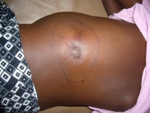Adamawa confirms eight deaths from suspected Buruli ulcer outbreak