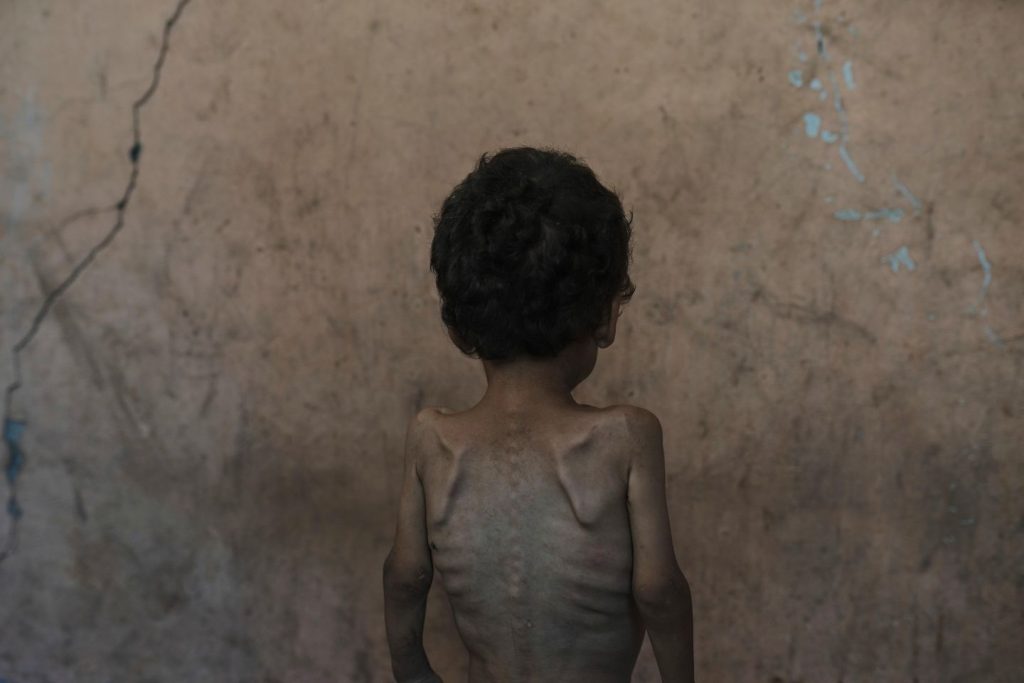 Practically 55,000 youngsters in Gaza beneath age 5 could also be acutely malnourished, a brand new U.N. examine finds